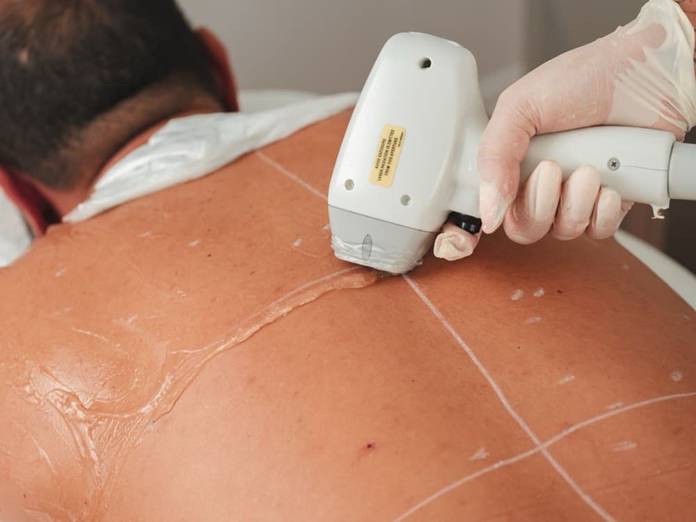 Laser hair reduction being carried out on the back